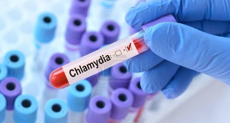 Arzt mit einem Reagenzglas mit Chlamydien-Test auf dem Hintergrund medizinischer Reagenzgläser mit Analysen.