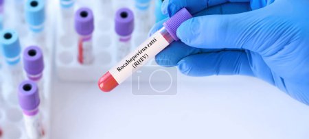 Doctor holding a test blood sample tube with Rocahepevirus, ratti, (RHEV) virus test on the background of medical test tubes. Cases of human infection with rat hepatitis E have been reported in Spain.
