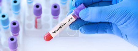 Arzt mit einem Reagenzglas mit Pankreatitis-Test auf dem Hintergrund medizinischer Reagenzgläser mit Analysen.