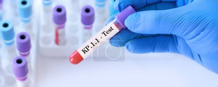 Doctor holding a test blood sample tube for the detection of the virus KP.1.1 on the background of medical test tubes. KP.1.1 , one of the FliRT variants. Symptoms with FLiRT are the same as with omicron