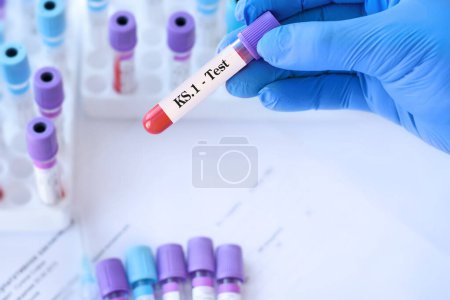 Médico sosteniendo un tubo de muestra de sangre de prueba para la detección del virus KS.1 en el fondo de los tubos de ensayo médicos. KS.1 una de las variantes de FliRT. Los síntomas con FLiRT son los mismos que con el omicrón