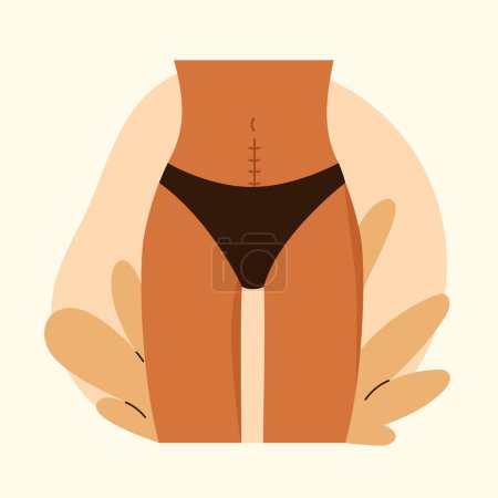 Photo for Cesarean scar. Stitches after caesarean section on female belly. C-section, surgical delivery operation concept. Vector illustration in cartoon style. Isolated white background. - Royalty Free Image