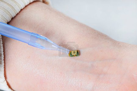 Foto de Un pequeño microcircuito se encuentra en la muñeca de una mano humana, es presionado por un instrumento médico junto a una vena, Health Modification Control by Nanotechnology. Proceso de instalación de chips. Corrección sanitaria - Imagen libre de derechos