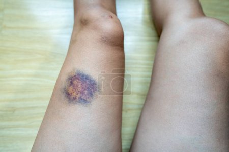 Téléchargez les photos : Bleus sur les jambes des femmes, accident. - en image libre de droit