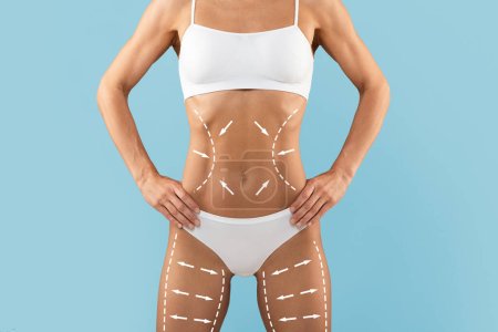 Photo for Liposuction Treatment. Cropped Shot Of Slim Young Female Body With Drawn Lifting Up Lines On It, Unrecognizable Lady In White Underwear Standing Isolated Over Blue Background, Collage With Copy Space - Royalty Free Image