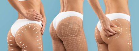 Lipolysis Concept. Set Of Perfect Female Buttocks With Drawn Lifting Up Lines And Mesh On It, Unrecognizable Slim Woman In Panties Showing Tight Skin On Hips After Beauty Treatments, Collage