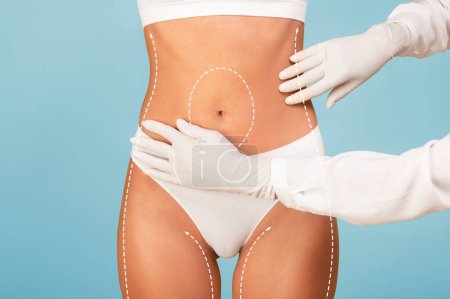 Concepto de Cirugía Plástica. Médico inspeccionando el cuerpo de la paciente femenina antes del tratamiento de liposucción, mujer joven en ropa interior con líneas discontinuas en la piel preparándose para el procedimiento estético, collage