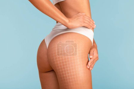 Photo for Cellulite Reduction. Cropped Shot Of Slim Female With Drawn Mesh On Hips, Closeup Of Young Woman In White Underwear With Perfect Tight Body Skin Enjoying Result Of Lipolysis, Collage - Royalty Free Image