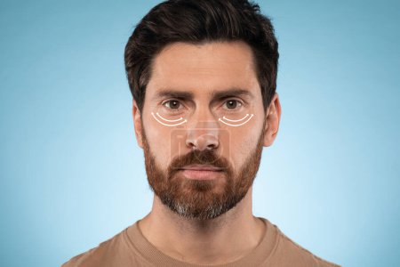 Téléchargez les photos : Handsome bearded man with marks under eyes for cosmetic surgery or correction, ready for operation, blue background. Plastic surgery concept - en image libre de droit