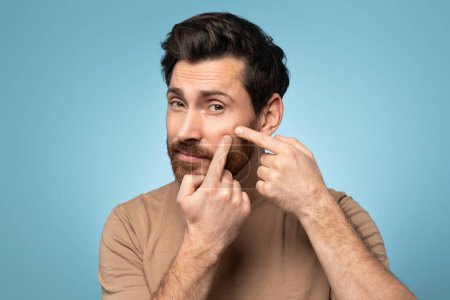 Foto de Portrait of bearded man touching his face, pressing pimple on face with fingers, looking at camera, blue studio background. Healthcare, stressful lifestyle hygienic acne concept - Imagen libre de derechos