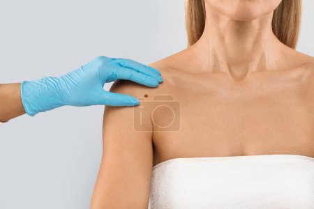 The doctors gloved hand checking mole nevus on unrecognizable womans shoulder, isolated on grey studio background. The concept of moles and skin cancer concept, cropped
