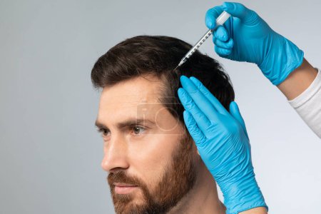 Mesotherapy for male hair. Handsome bearded man receiving injections in his head, having mesotherapy session at beauty salon, therapist in protective glove with syringe, closeup