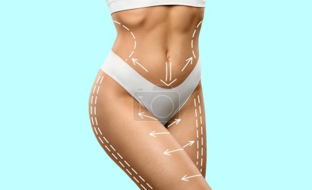 Photo for Cropped of slim woman in white lingerie enjoys weight loss result with abstract lines on perfect body, isolated on blue wall background, studio. Drainage massage and beauty care - Royalty Free Image