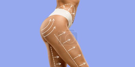 Photo for Beautiful well-fit hips with white massage lines of woman wearing white panties on purple studio background, cropped, panorama with copy space. Body shaping, sculpting treatment - Royalty Free Image