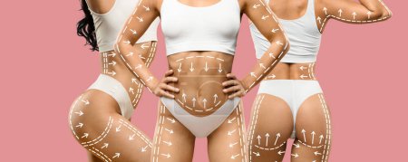 Photo for Side, front and back view of unrecognizable lady in white underwear with white pen marks on her hips, buttocks and belly, getting ready for body sculpting surgery, pink background, collage - Royalty Free Image