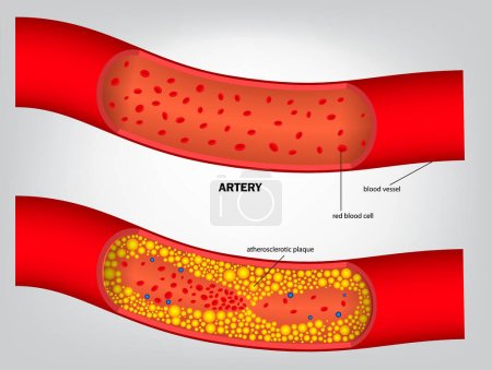 Ilustración de Tipo realista de colesterol en la arteria aislada. eps vector - Imagen libre de derechos