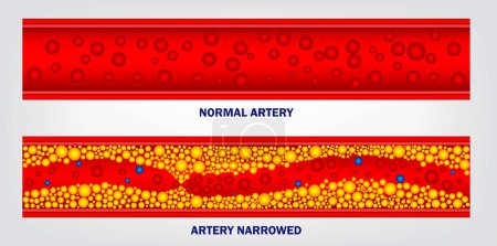 Illustration for Realistic type of cholesterol in artery isolated. eps vector - Royalty Free Image