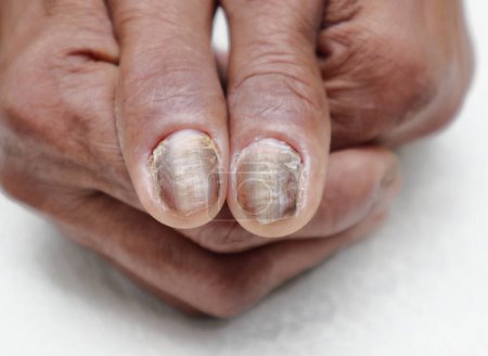 Téléchargez les photos : Vue rapprochée des ongles gâtés d'une patiente diabétique asiatique âgée - en image libre de droit