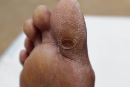 Una vista de cerca de una úlcera del pie diabético que se ha curado completamente en la parte inferior de un dedo gordo del pie