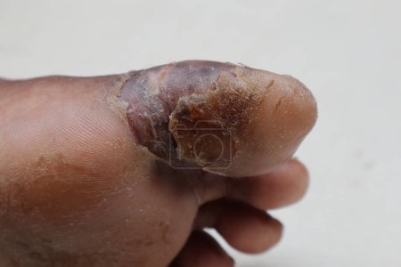 Photo for Angle view of a diabetic foot ulcer on underside of a big toe of an Asian female diabetic patient, the ulcer is now slowly healing - Royalty Free Image