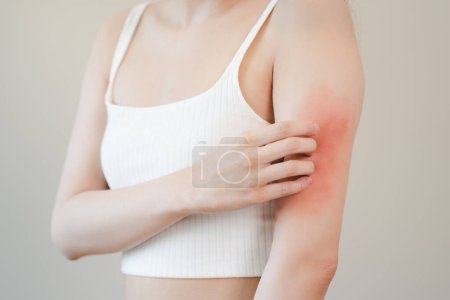 Photo for Sensitive skin allergic concept, Woman itching on her arm have a red rash from allergy symptom and from scratching. - Royalty Free Image