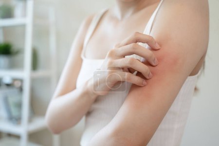 Concepto alérgico a la piel sensible, la mujer que pica en su brazo tiene una erupción roja de síntoma de alergia y de arañazos.