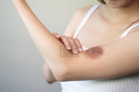 Photo for Woman get injured and have bruised on her arm. - Royalty Free Image