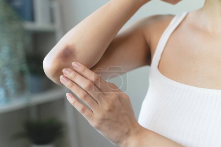 Photo for Woman get injured and have bruised on her arm. - Royalty Free Image