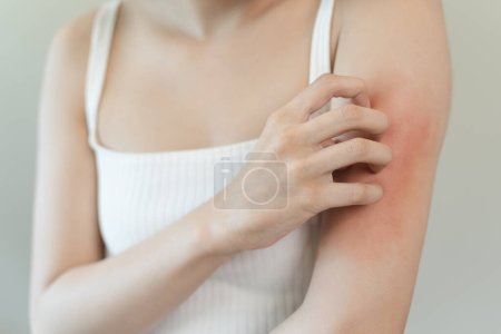 Empfindliche hautallergische Konzept, Frau Juckreiz auf dem Arm haben einen roten Ausschlag von Allergie-Symptom und von Kratzen.