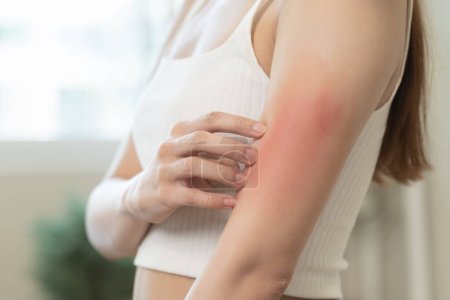 Téléchargez les photos : Concept allergique cutané sensible, démangeaisons femme sur son bras ont une éruption cutanée rouge de symptômes d'allergie et de rayures. - en image libre de droit