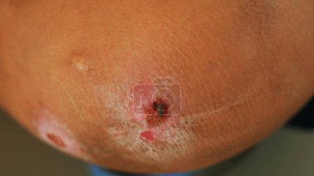 Photo for The abrasion wound is infected with flies and unclean diseases. - Royalty Free Image