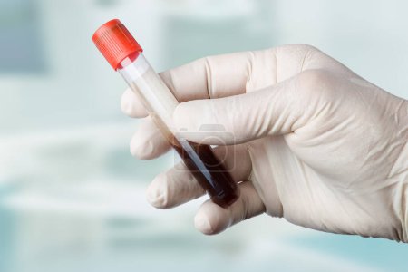 Nahaufnahme der Hand in medizinischen Handschuhen bei der Handhabung eines Blutteströhrchens zur Analyse