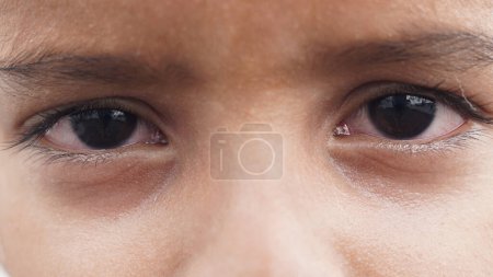 Photo for Close up of two annoyed red blood eyes of male affected by conjunctivitis or after flu, cold or allergy. Concept of health, disease and treatment. Copy space for advertisement. - Royalty Free Image