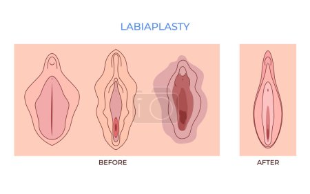 Ilustración de Labiaplastía. vaginoplastia. mujeres genitales de menor importancia vulval labios sueltos cirugía de belleza para apretar - Imagen libre de derechos