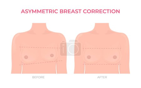 Illustration for Asymmetric breast correction before and after plastic surgery front view - Royalty Free Image
