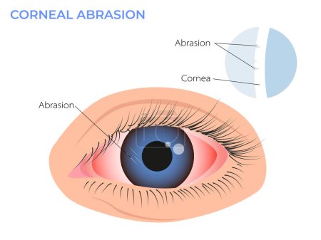 Illustration des Hornhautabriebs. Augenrötung Symptom. rosarotes Surferauge