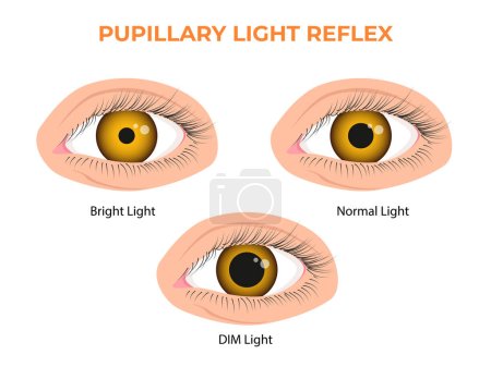 Ilustración de Reflejo de luz pupilar RLP o reflejo fotopupilar - Imagen libre de derechos