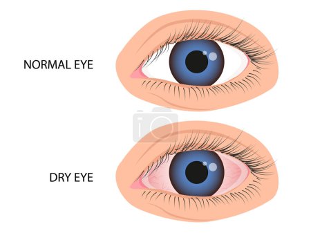 Human eye healthy and dry. Symptoms of keratitis, allergy, conjunctivitis, uveitis
