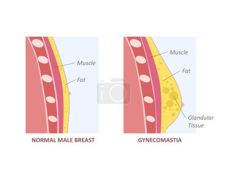 Hormone imbalance between estrogens and androgens. Gynecomastia