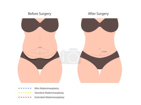 Illustration for Abdominoplasty tummy tuck surgery. skin fat loss - Royalty Free Image