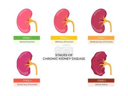 Illustration for Stages of chronic kidney disease. Problem in urinary system and normal kidney - Royalty Free Image