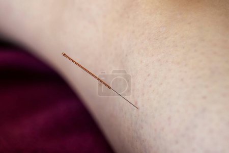 Photo for A close up portrait of an acupuncture needle sticking into a persons skin and body to heal or relax. An acupuncturist provides this alternative medicine to cure illness, pain or for stress relief. - Royalty Free Image