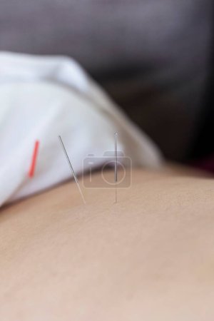 Photo for A close up portrait of an acupuncture needle sticking into a persons skin and body to heal or relax. An acupuncturist provides this alternative medicine for stress relief or to cure illness or pain. - Royalty Free Image