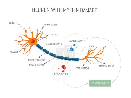 Téléchargez les illustrations : Infographie d'un neurone endommagé par une attaque de lymphocytes et de macrophages qui détruit la myéline dans la sclérose en plaques. - en licence libre de droit