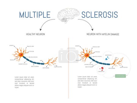 Infographic of a healthy neuron and one with damage from attack by myelin-destroying lymphocytes and macrophages in multiple sclerosis disease.
