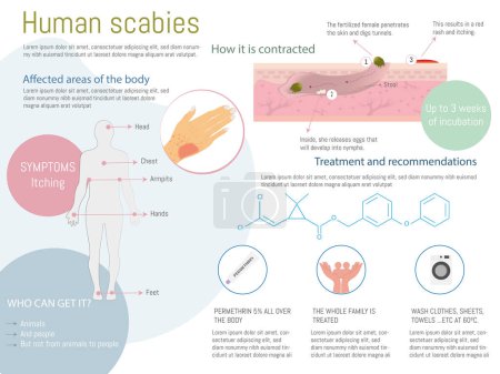 Scabies in humans infographic. How it spreads, treatment, symptoms with corresponding icons on white background. Flat design