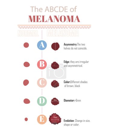 The ABCDE of melanoma, to know if you have a melanoma, on a white background.