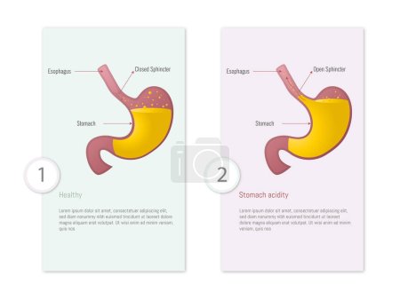 Infografik des Magens, wenn er gesund ist und wenn Magensäure vorhanden ist, auf farbigem Hintergrund zur Unterscheidung und weißem Hintergrund. Erklärung des Säureprozesses.