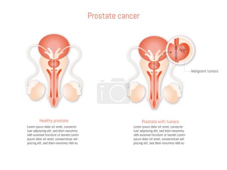 Téléchargez les photos : Infographie sur le cancer de la prostate sur fond blanc. Anatomie des organes reproducteurs masculins. prostate saine et cancer. - en image libre de droit