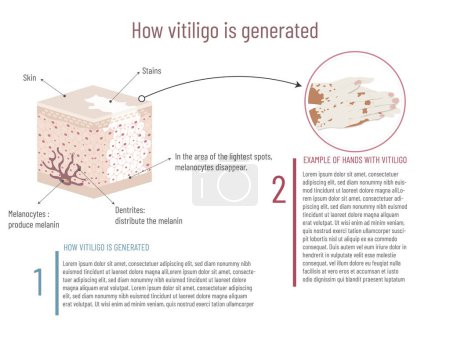 Illustration for Infographic of the origin of vitiligo and visual example on the hands, skin structure and affected area on white background. - Royalty Free Image